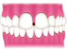 空隙歯列（すきっ歯）